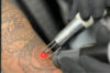 Close-up of laser tattoo removal in progress on a dragon tattoo, performed by a specialist in gloves.